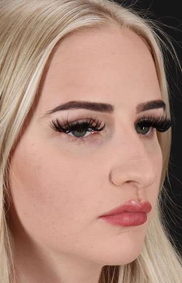 Brow Lift Before & After Patient #4876