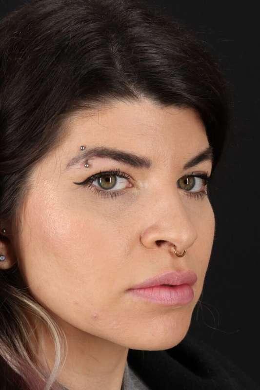 Brow Lift Before & After Patient #4912