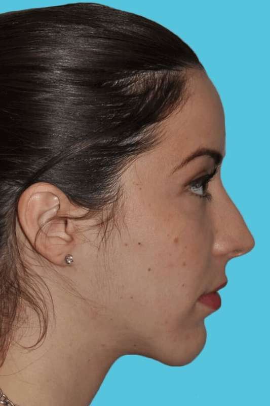 Chin Surgery Before & After Patient #4928