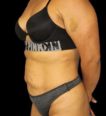 Abdominoplasty (Tummy Tuck) Before & After Patient #601