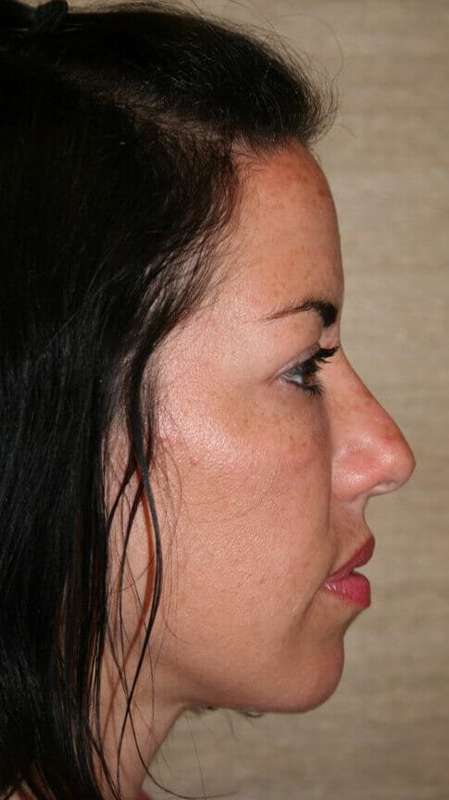 Chin Surgery Before & After Patient #4936