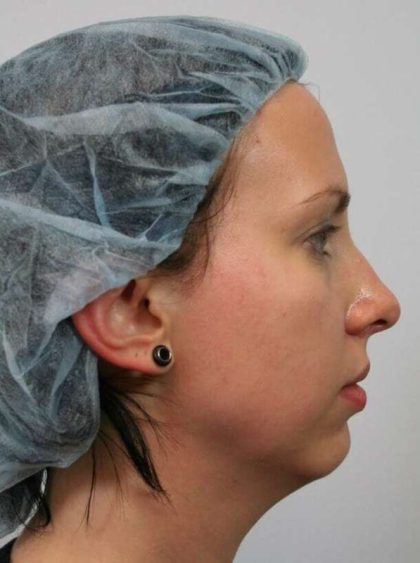 Chin Surgery Before & After Patient #4944