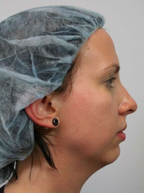 Chin Surgery Before & After Patient #4944