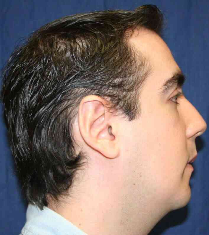 Chin Surgery Before & After Patient #4949