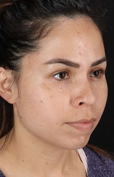 Cosmetic Injectables Before & After Patient #4990