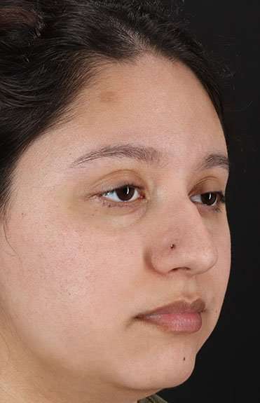 Cosmetic Injectables Before & After Patient #5001