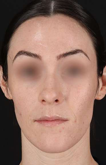 Cosmetic Injectables Before & After Patient #5016