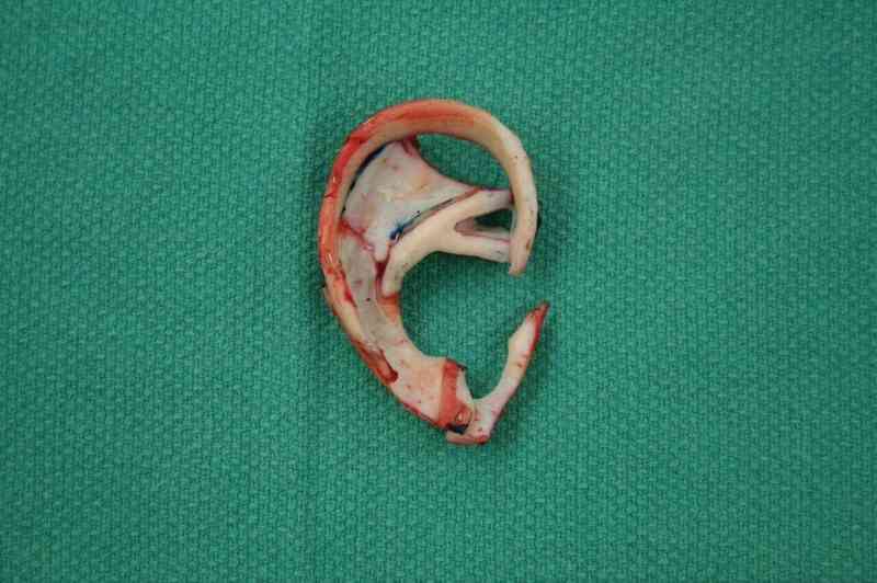 Ear Reconstruction / Microtia Before & After Patient #5031