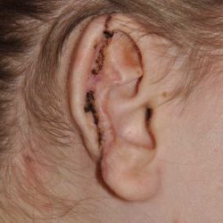 Ear Reconstruction / Microtia Before & After Patient #5045