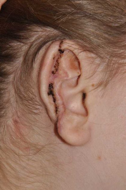 Ear Reconstruction / Microtia Before & After Patient #5045