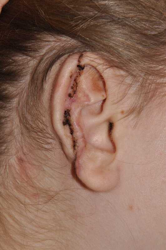 Ear Reconstruction / Microtia Before & After Patient #5045
