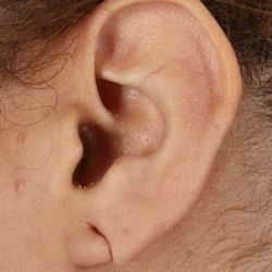 Earlobe Repair Before & After Patient #5053