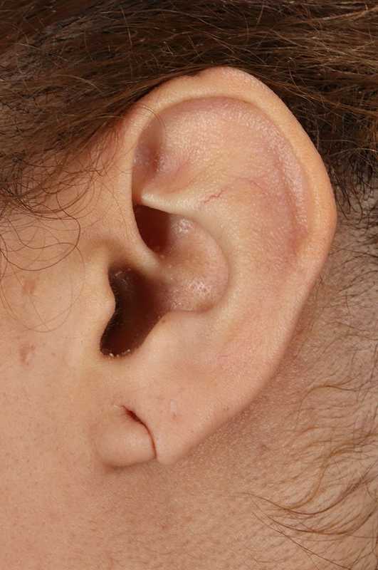 Earlobe Repair Before & After Patient #5053