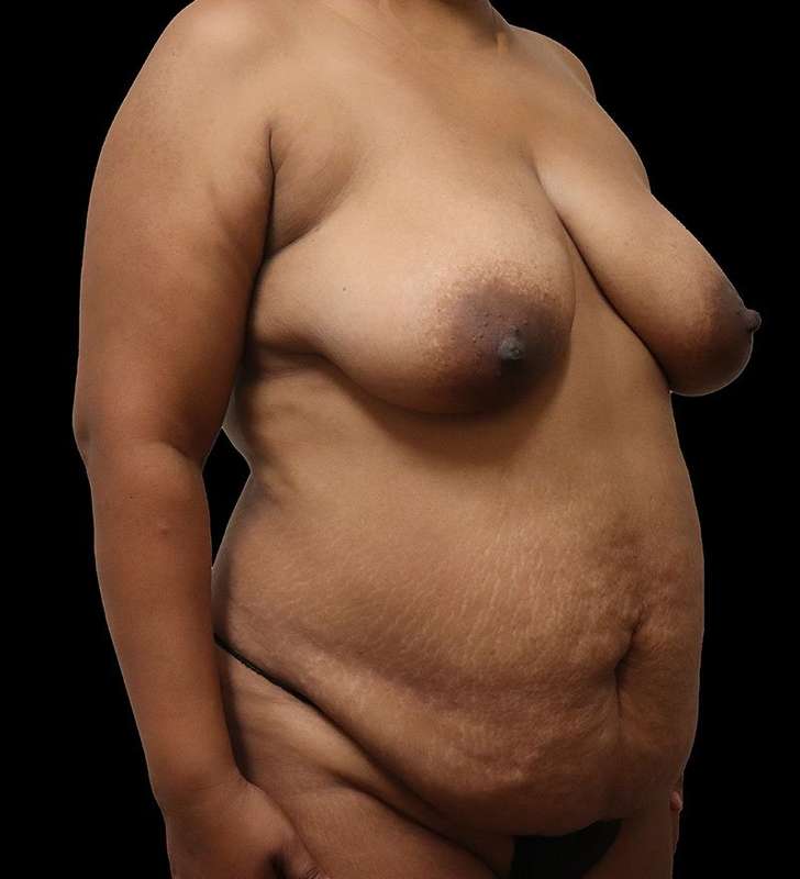 Abdominoplasty (Tummy Tuck) Before & After Patient #975