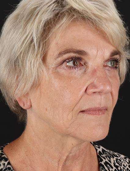 Facelift Before & After Patient #5163