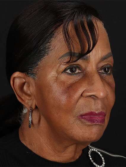 Facelift Before & After Patient #5196