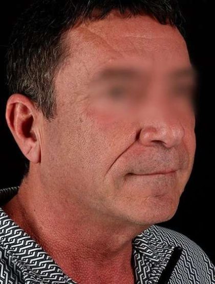 Facelift Before & After Patient #5207