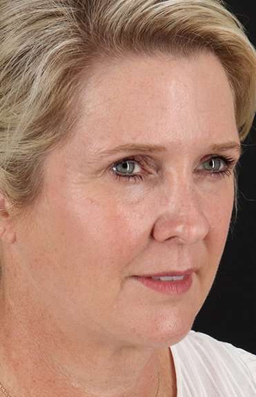 Facelift Before & After Patient #5229