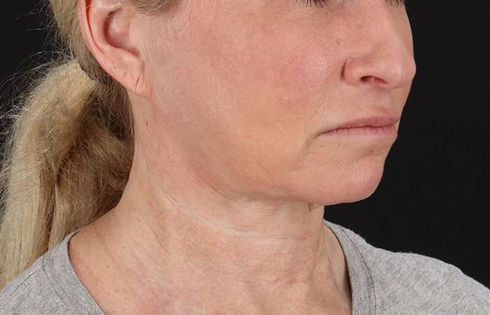Facelift Before & After Patient #5240