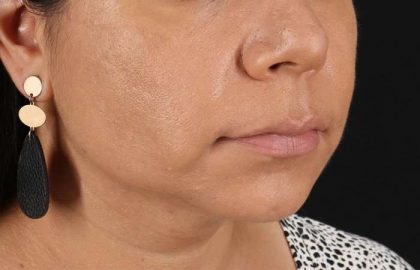 Facelift Before & After Patient #5251