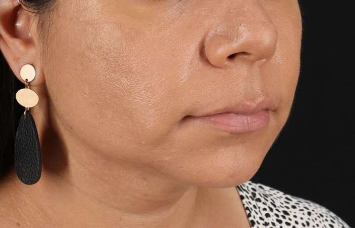 Facelift Before & After Patient #5251