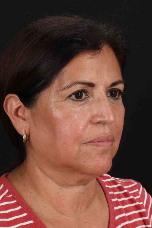 Facelift Before & After Patient #5284