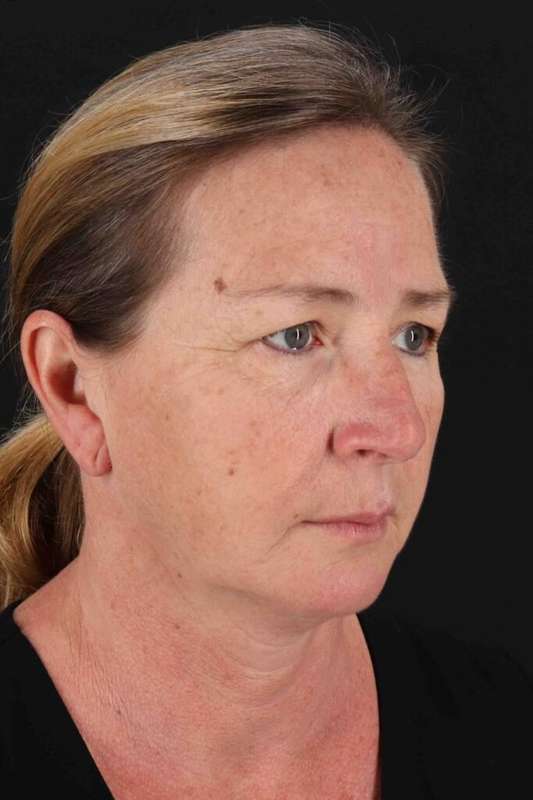 Facelift Before & After Patient #5295