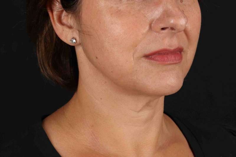 Facelift Before & After Patient #5315