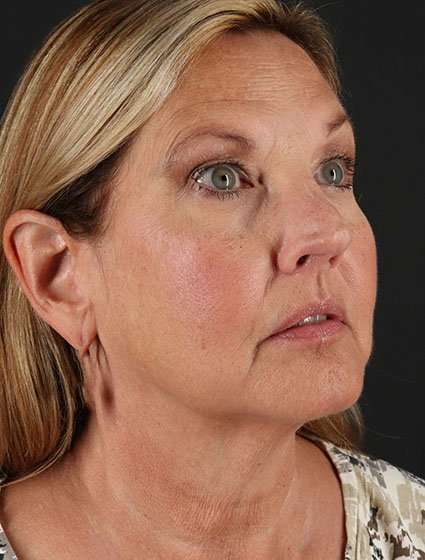 Facelift Before & After Patient #5348