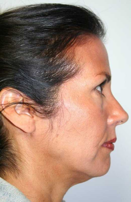 Facelift Before & After Patient #5367