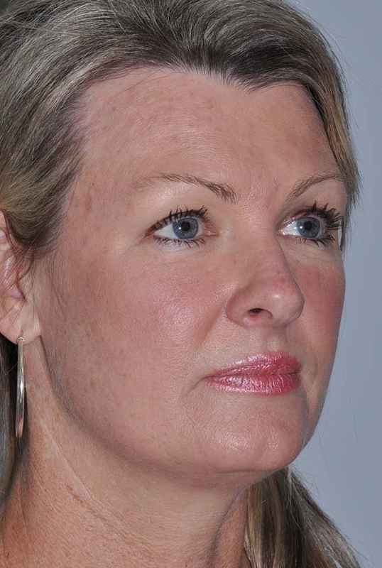 Facelift Before & After Patient #5385