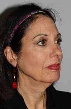 Facelift Before & After Patient #5399