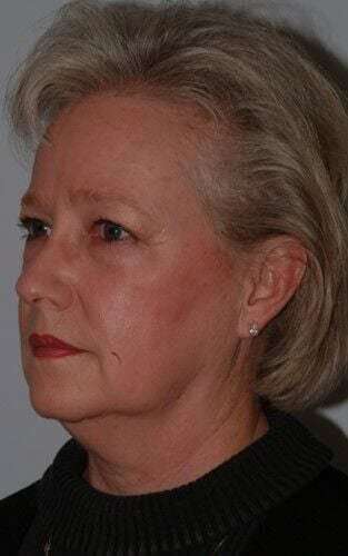 Facelift Before & After Patient #5424