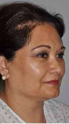 Facelift Before & After Patient #5438