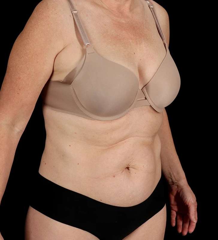 Abdominoplasty (Tummy Tuck) Before & After Patient #1029