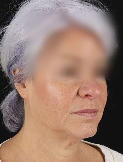Facelift Before & After Patient #5499