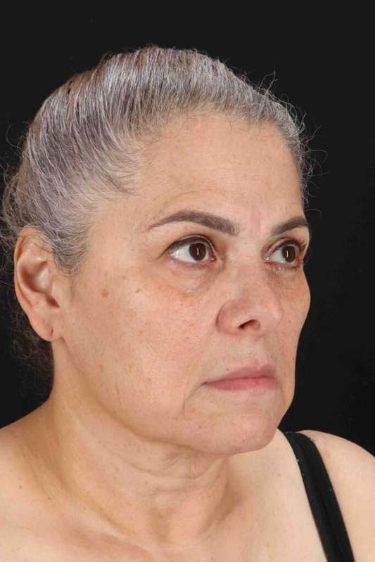 Facelift Before & After Patient #5510