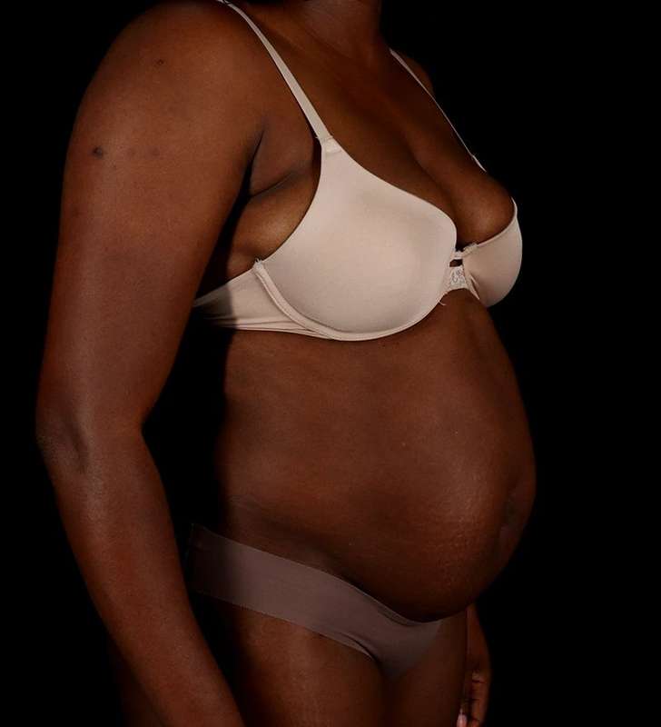 Abdominoplasty (Tummy Tuck) Before & After Patient #1045