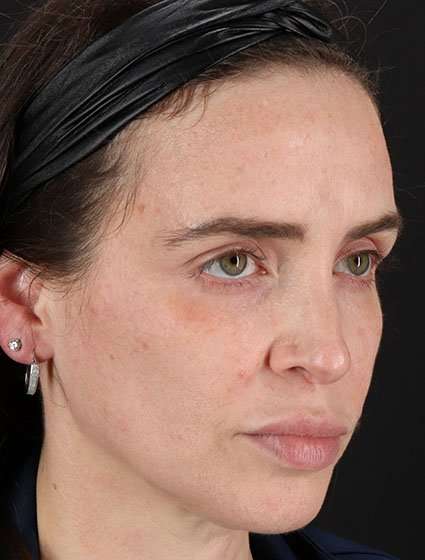 Chemical Peels Before & After Patient #5579