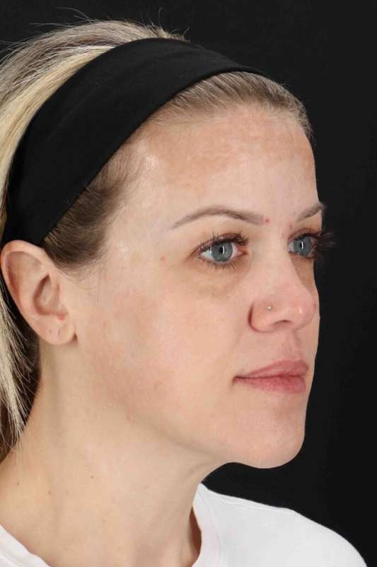Chemical Peels Before & After Patient #5601