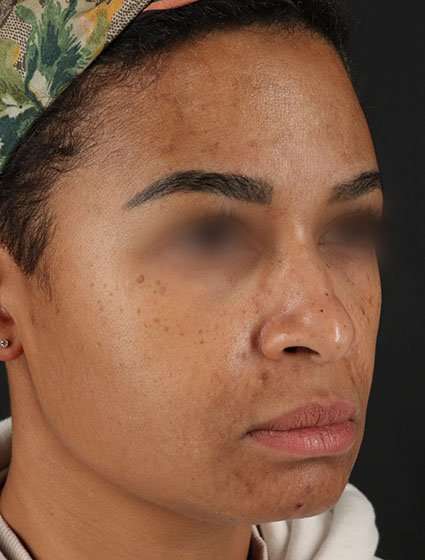 Chemical Peels Before & After Patient #5610