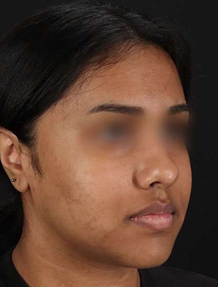 Chemical Peels Before & After Patient #5621