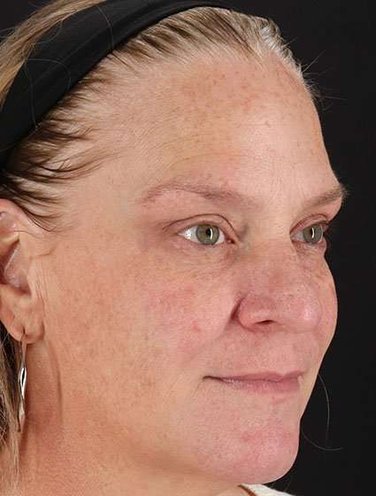 Chemical Peels Before & After Patient #5632