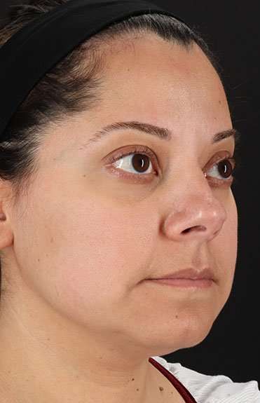 Neck Liposuction Before & After Patient #5720