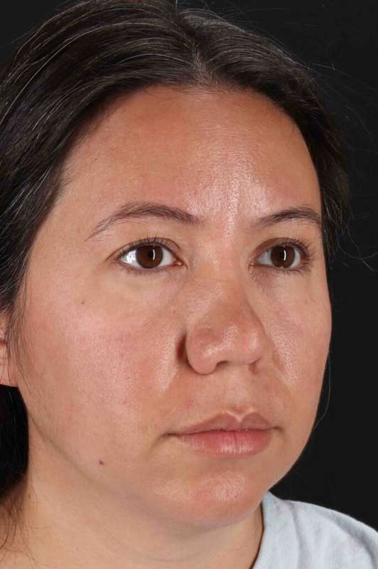 Neck Liposuction Before & After Patient #5731