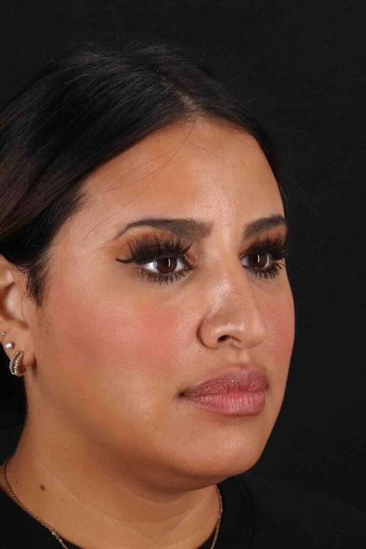 Neck Liposuction Before & After Patient #5762