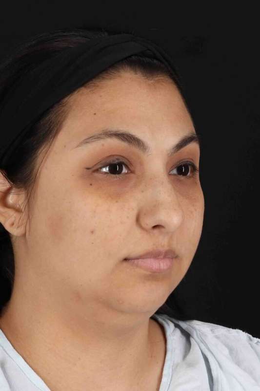 Rhinoplasty Before & After Patient #5826