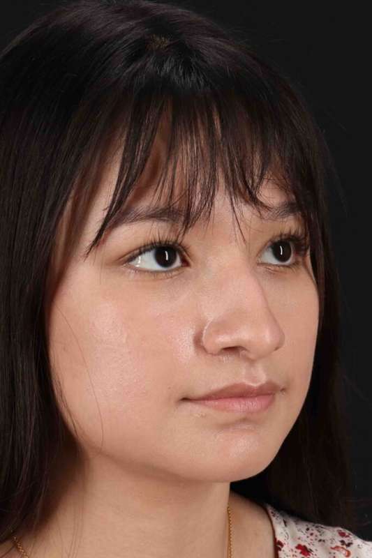 Rhinoplasty Before & After Patient #5837