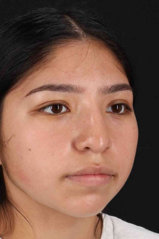 Rhinoplasty Before & After Patient #5848