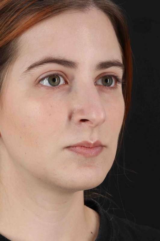 Rhinoplasty Before & After Patient #5859